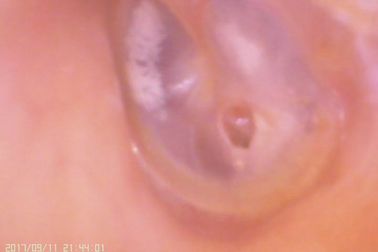 Videooor en Neusc amera Digitale Oorspiegel voor Perforatie van het Tympanic Membraan