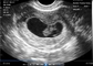 Transvaginale endocavity draagbare zwangerschapsscanner voor OB / GYN draagbare echografie