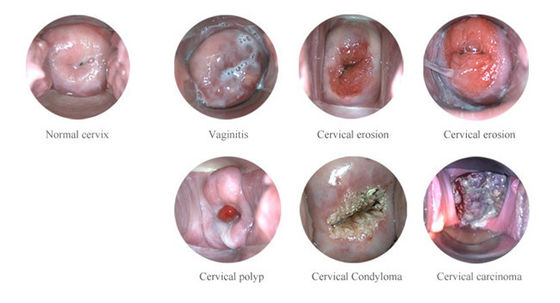 Draagbare Digitale Elektronische Colposcoop