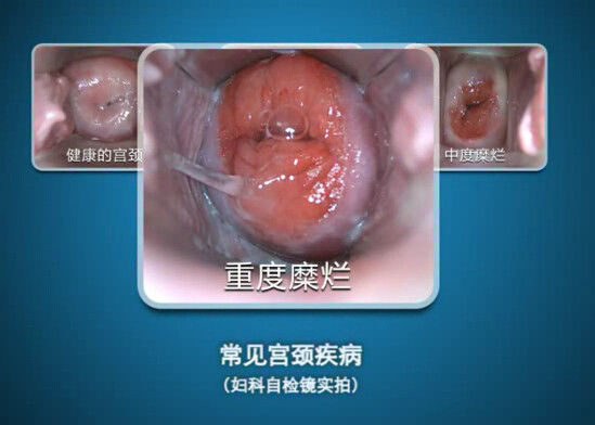 De digitale Endoscoop zelf-inspecteert Colposcope Minicolposcopy met Waaier van Observatie 70~100mm