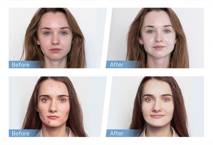 Fabrieksverkoop Hydra Pen H5 EMS Elektrische Microneedling Pen voor Collageenregeneratie Haar Baard Teruggroei Thuis en Salon Gebruik 4